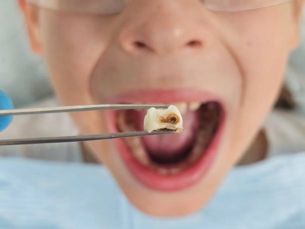 Best Emergency Wisdom Teeth Removal in Trexlertown, PA